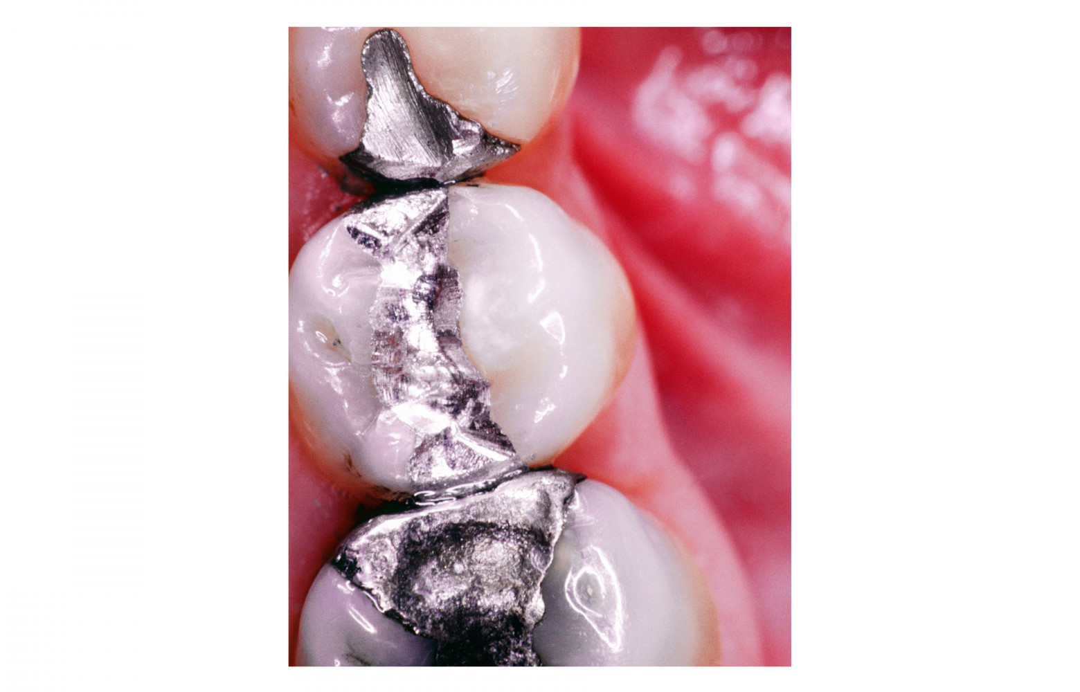 "Dental Fillings, CNRI" d’Elad Lassry.
